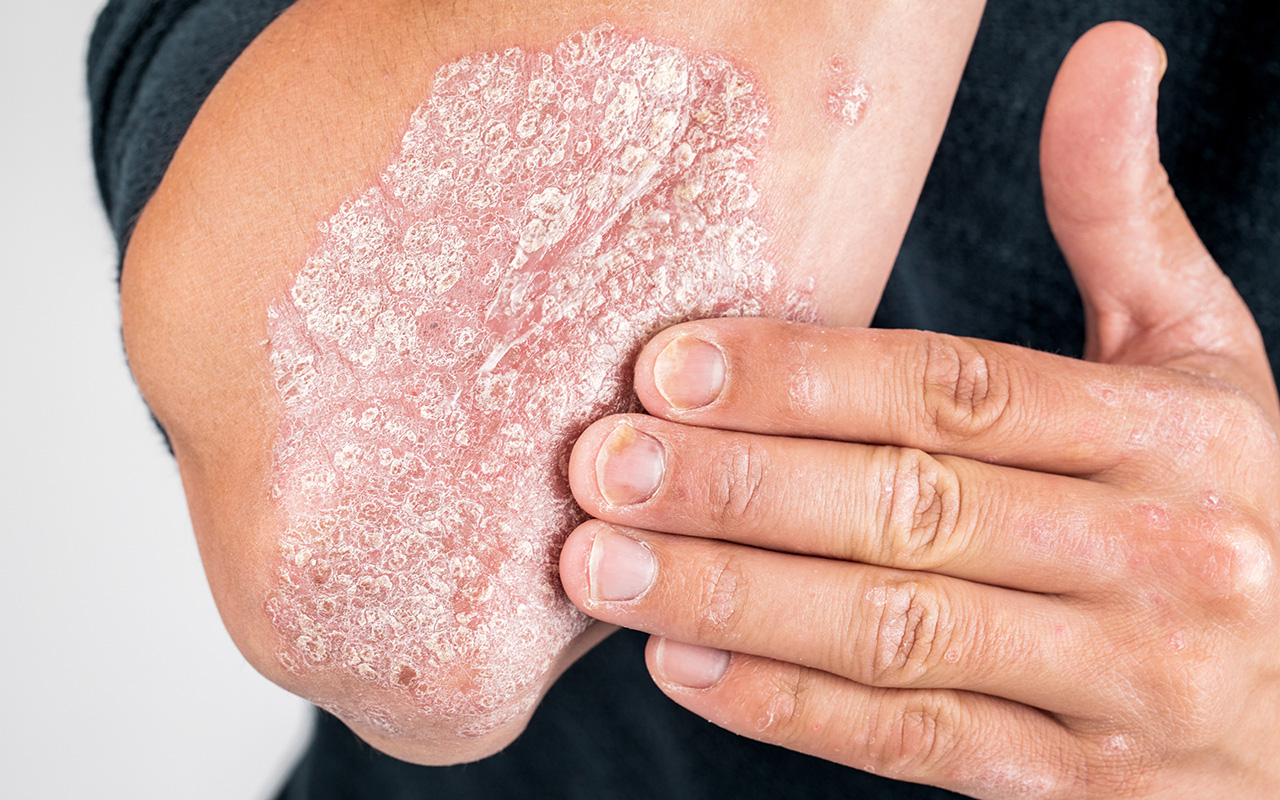 More To Psoriasis Than A Skin Condition Insight