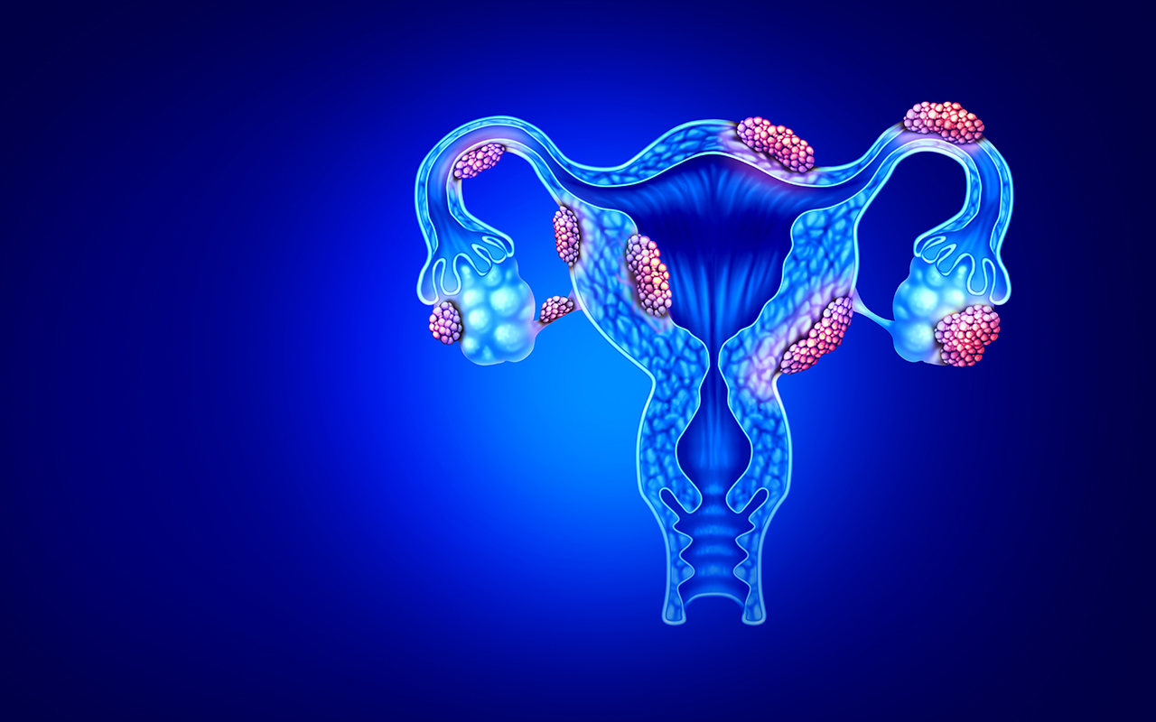 12 Signs of Endometriosis to Know, Because It's Not Just Period Pain