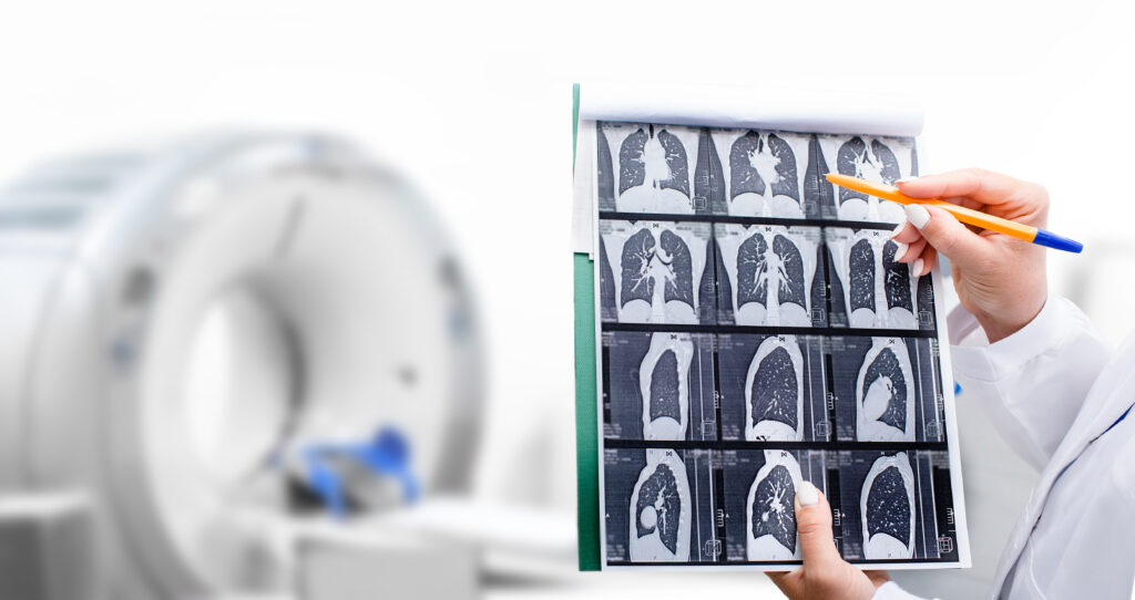 'World leading' lung cancer screening could save 500 lives each year - Featured Image