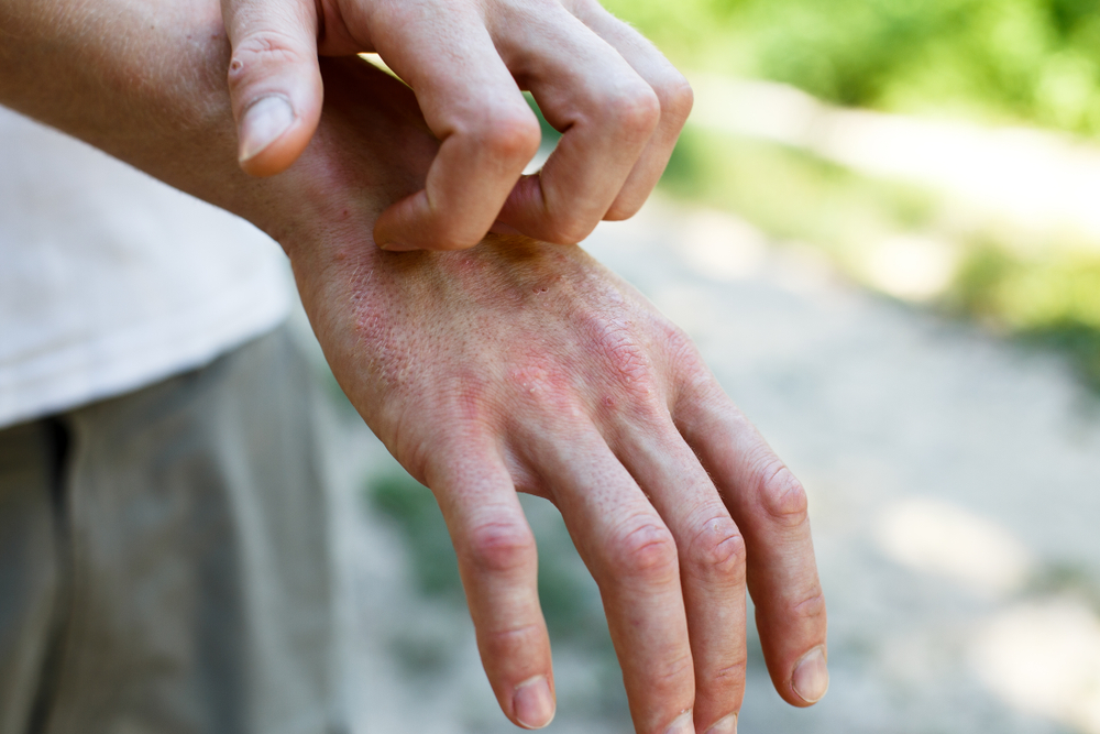 Eczema - Featured Image
