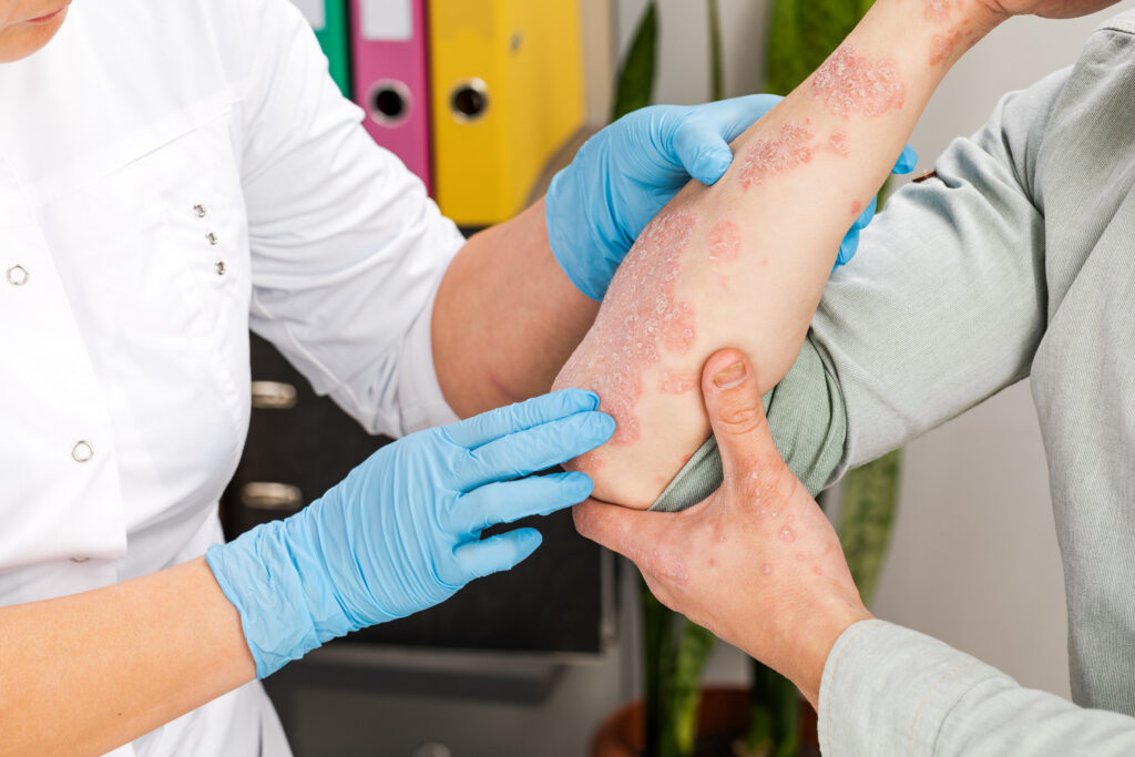 Dermatology dilemma: Rethinking psoriasis and its comorbidities - Featured Image