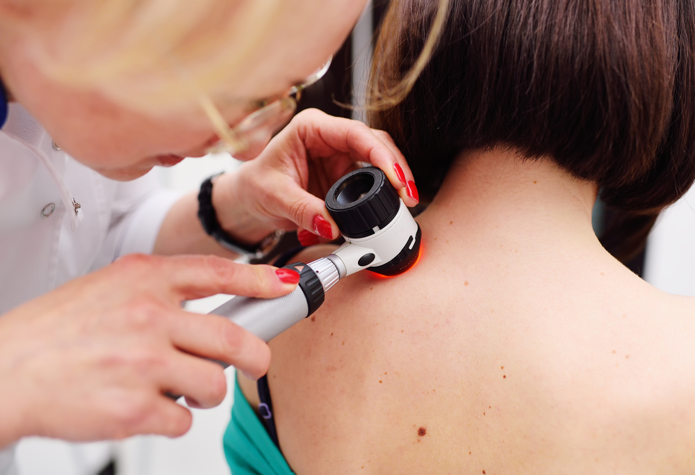 GPs needed to keep Melanoma care equitable across Queensland - Featured Image