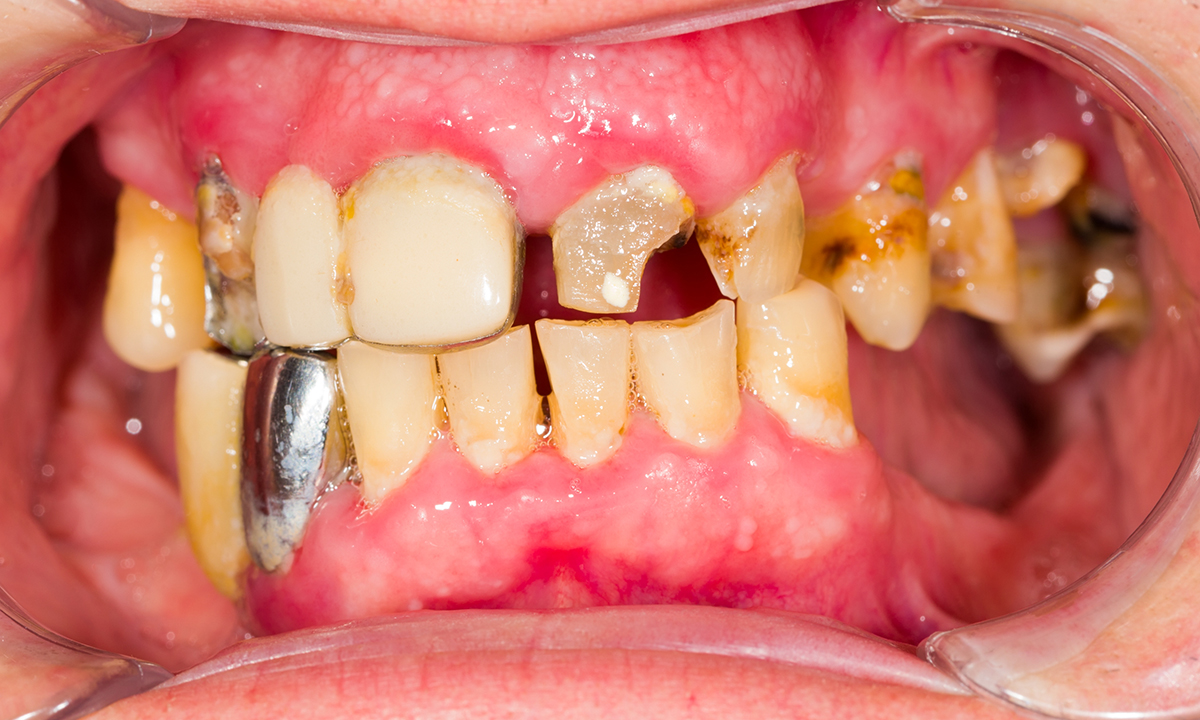 What Cause Poor Dental Health